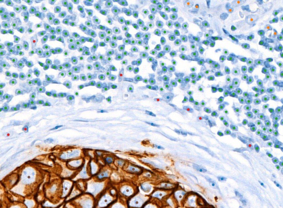 HER2 IHC with Nemo detections