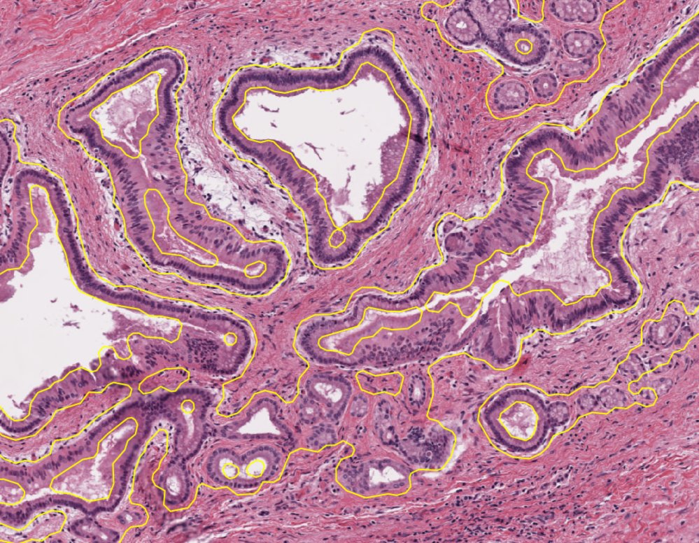 Pancreatic ductal adenocarcinoma on H&E with every duct contour drawn by Octo Duct