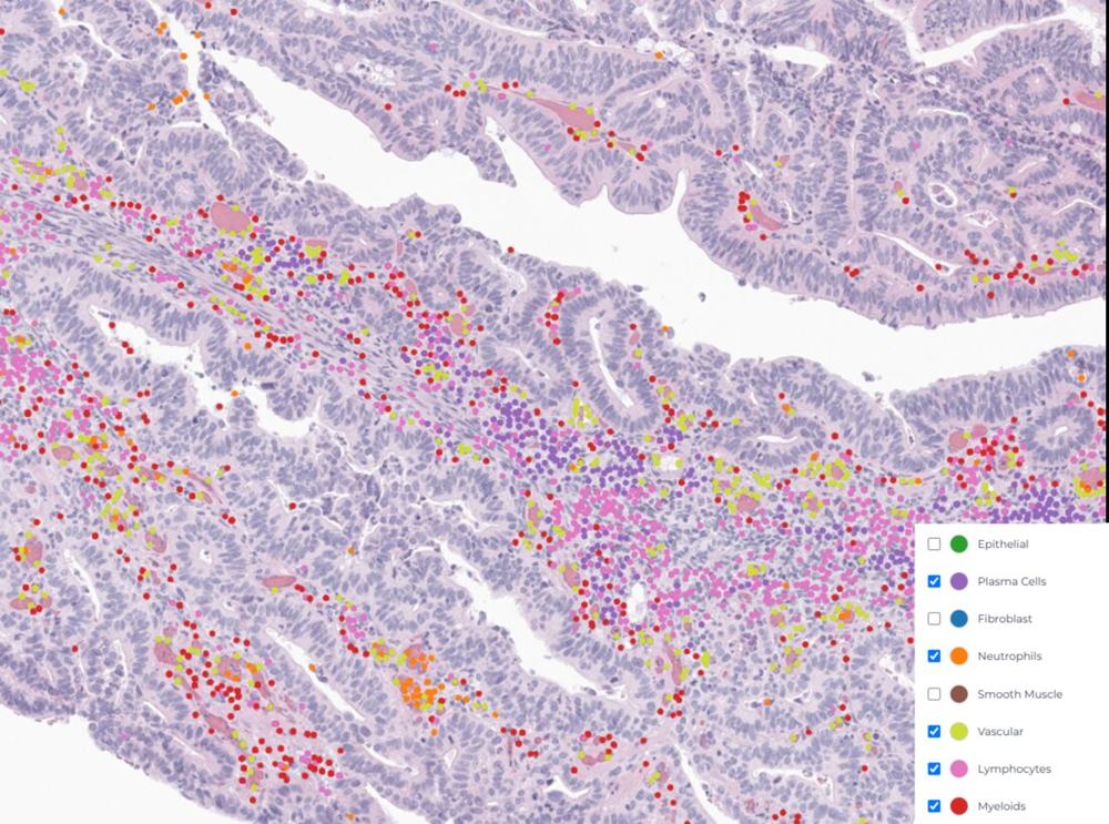 Immune contexture across a tumour bed on H&amp;E
